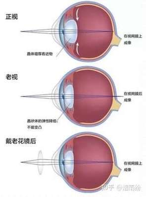 老花眼去医院配眼镜好还是去眼镜店