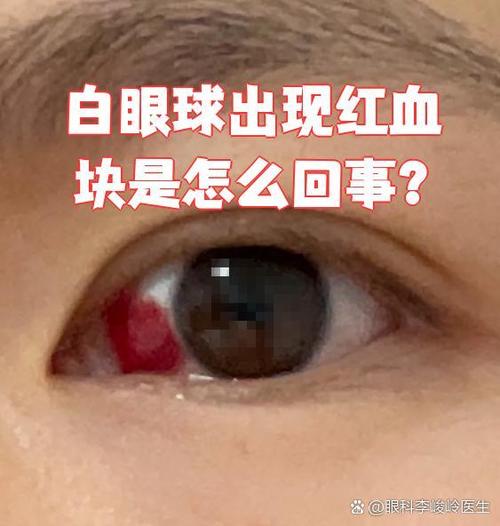 眼睛里有红血块是什么原因