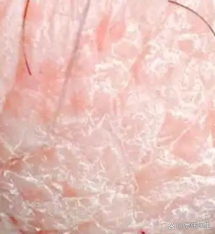 男性真菌感染图片