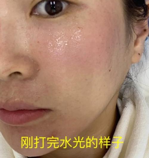 打了水光变黄