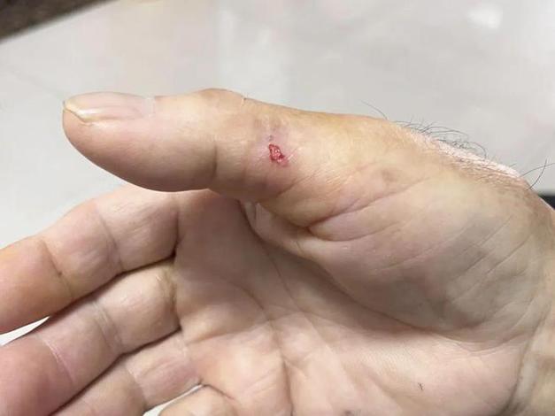被仓鼠咬了要打破伤风吗