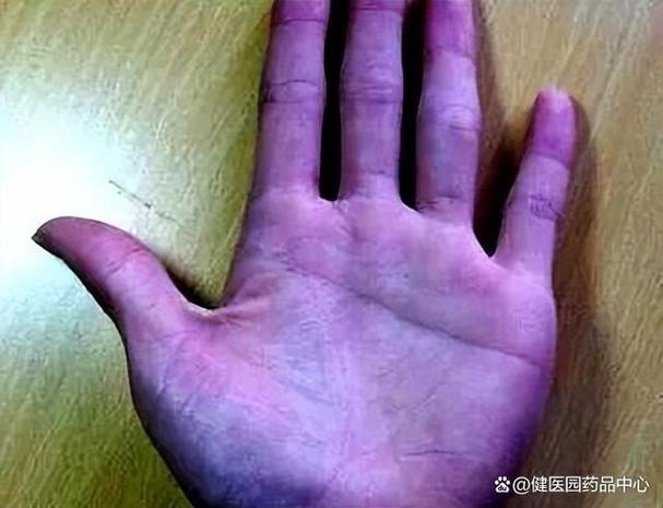 手掌紫色